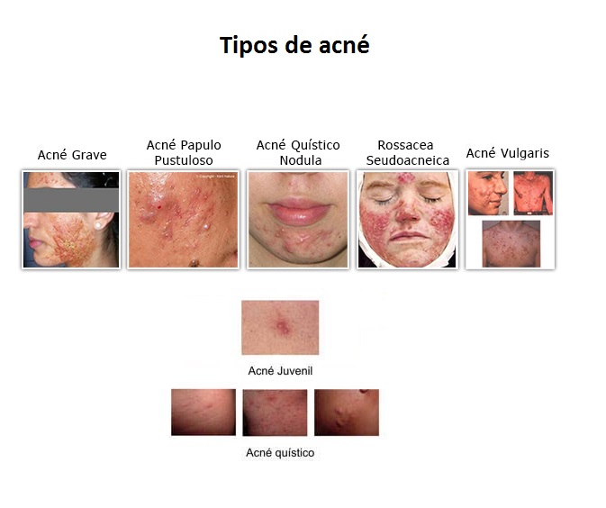 Tipos y clases de acné