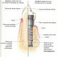 tipos de implantes dental